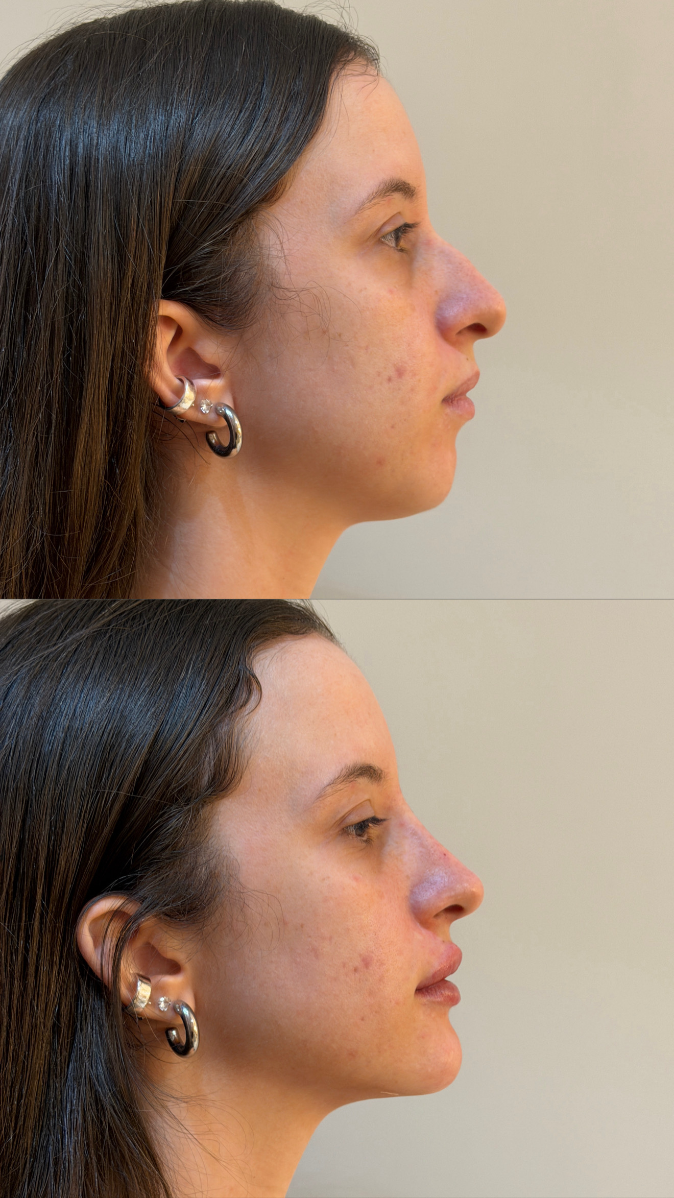 Caso de aluno formado — perfiloplastia