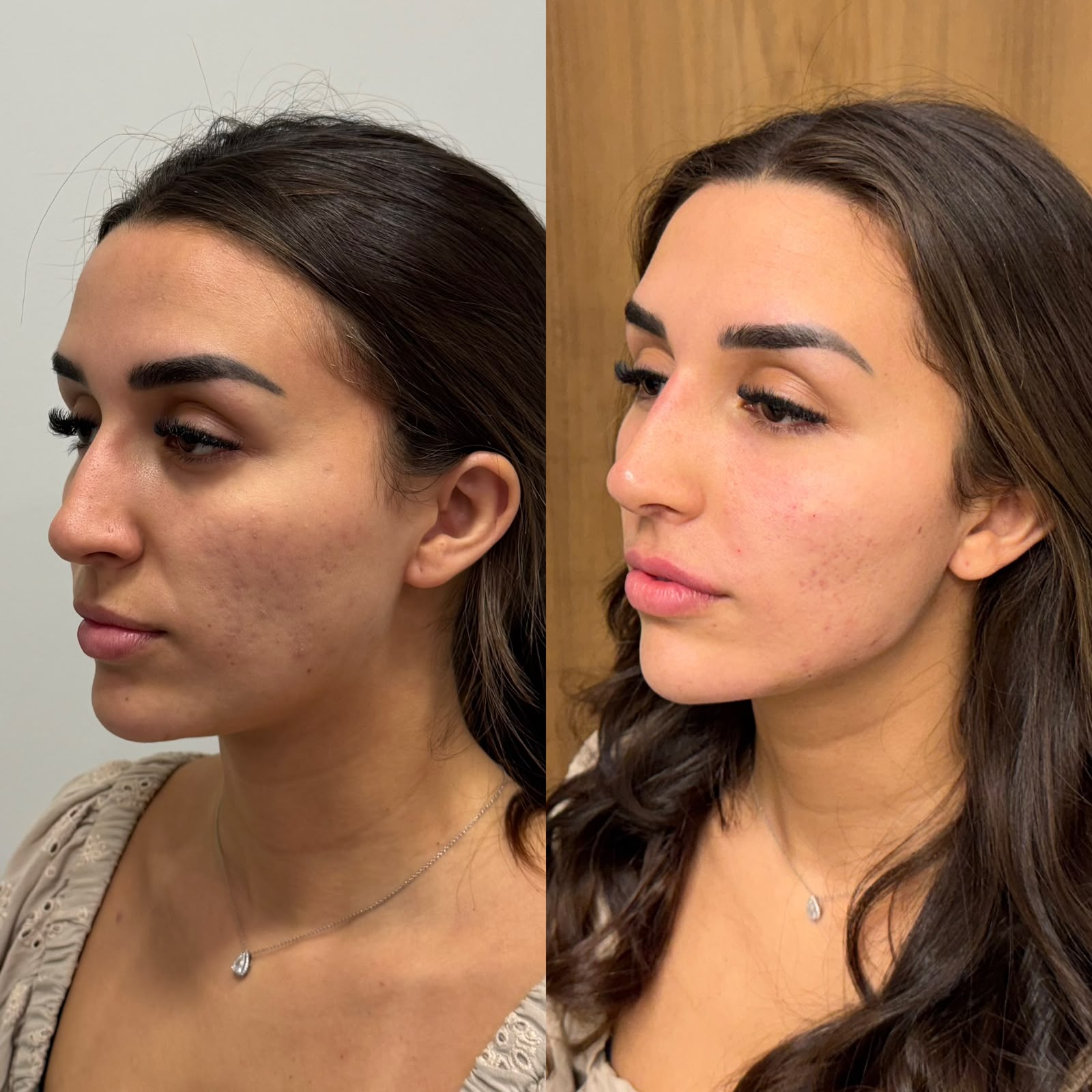 Harmonização facial