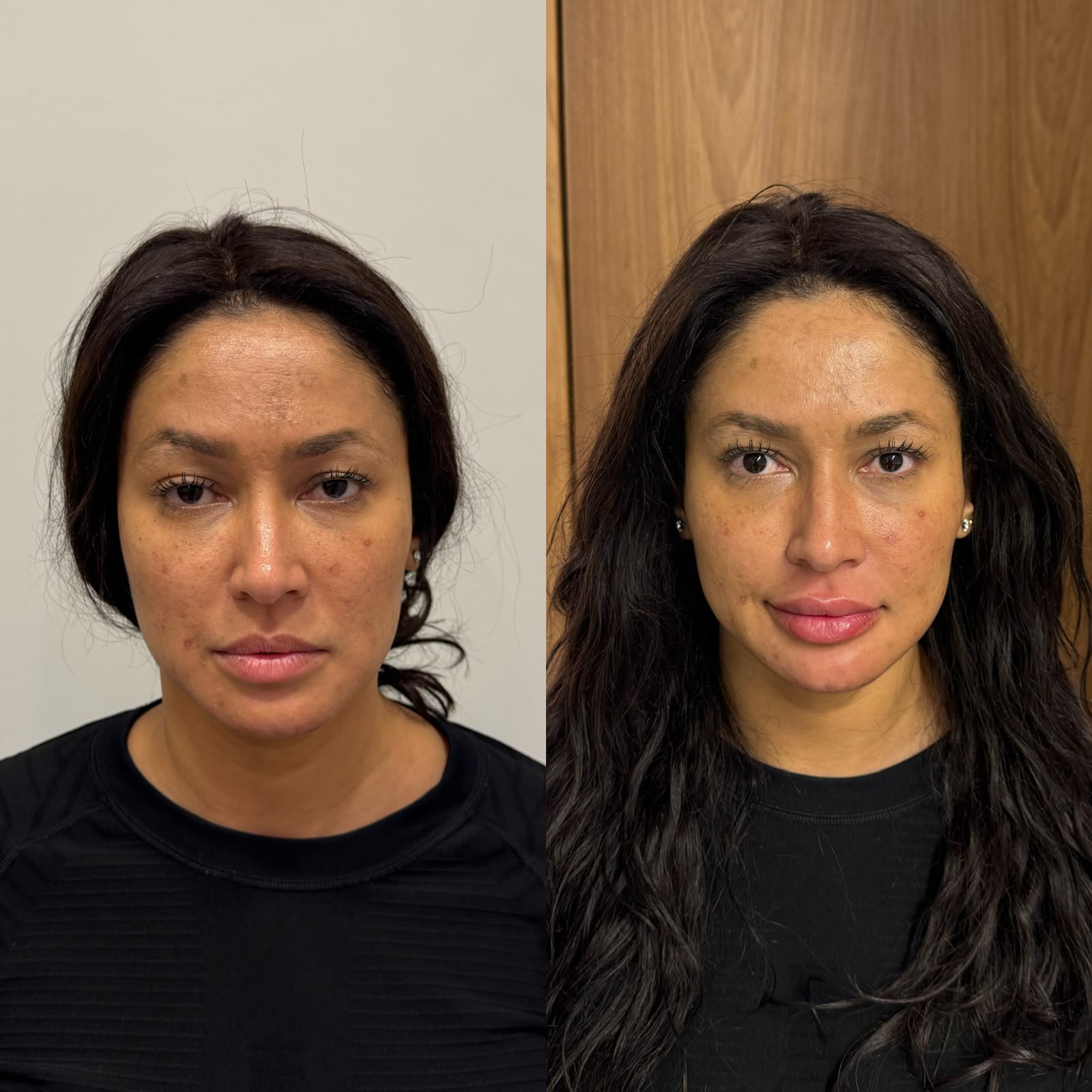 Harmonização facial