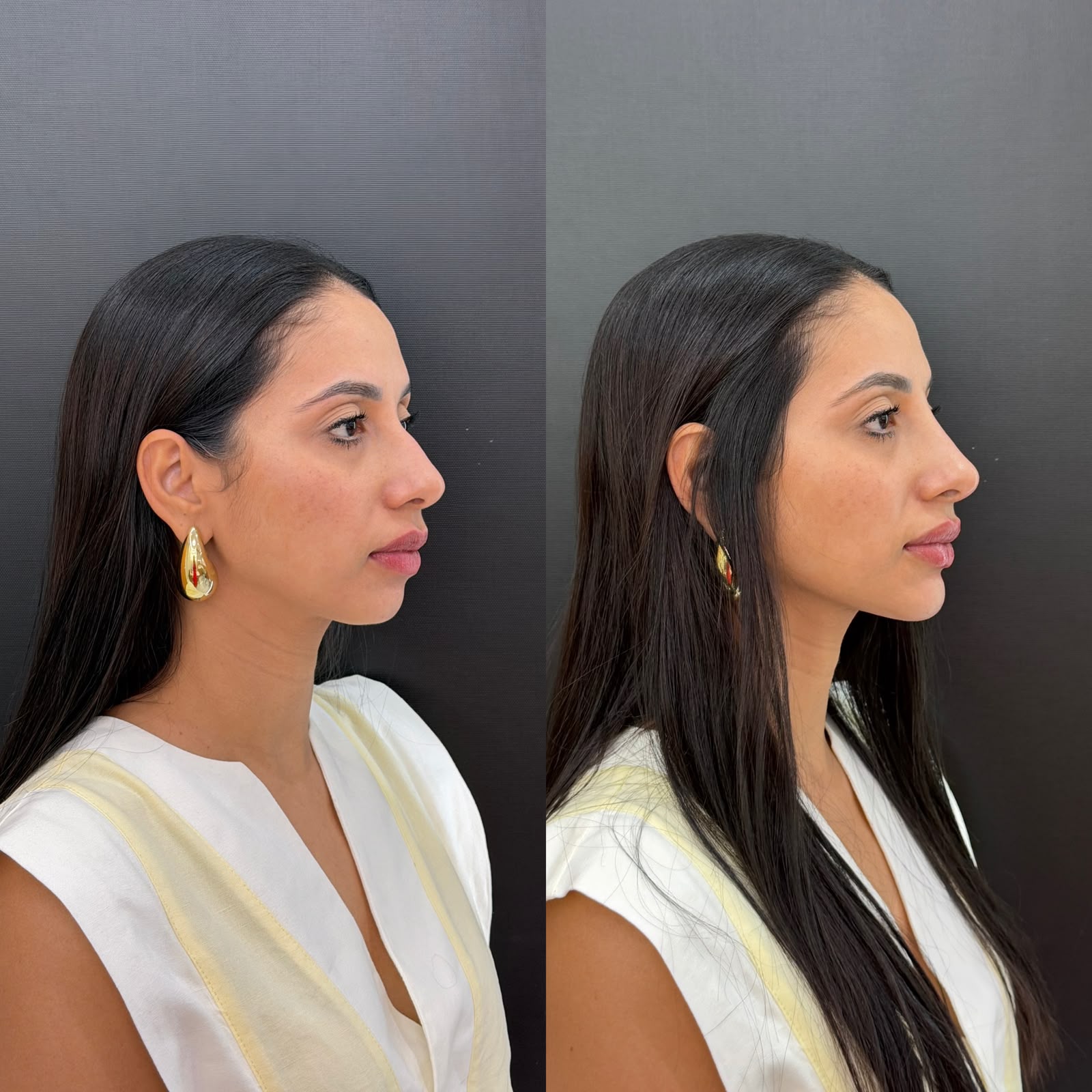 Perfiloplastia