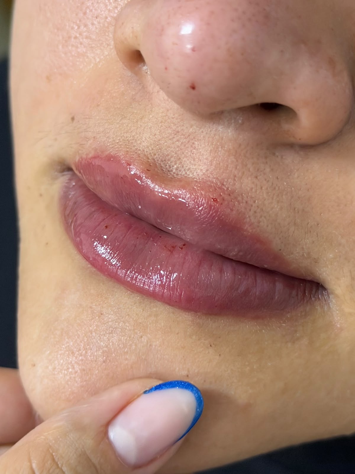 Preenchimento labial