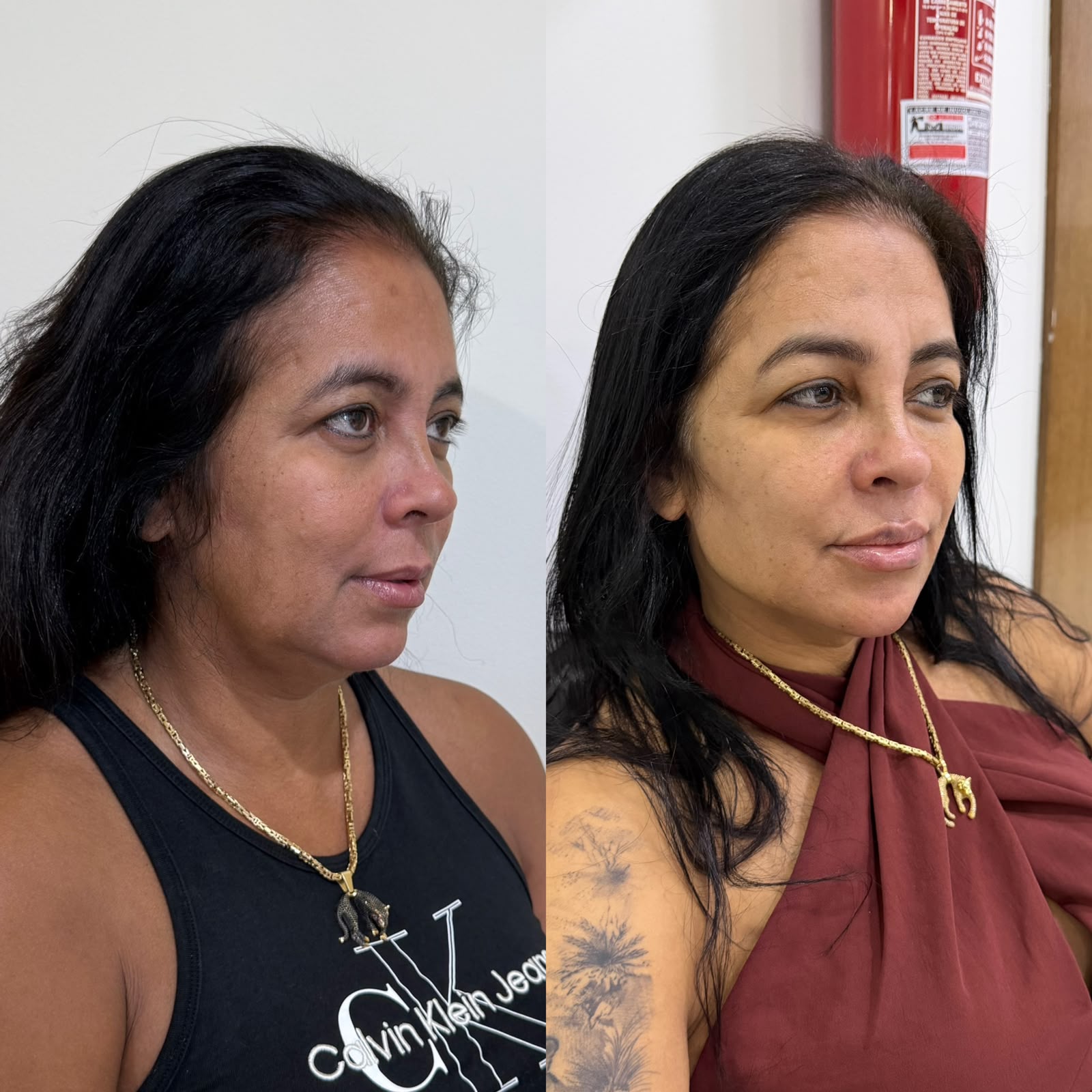Harmonização facial, pele madura